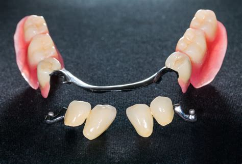 protesis parcial removible - protesis dental removible